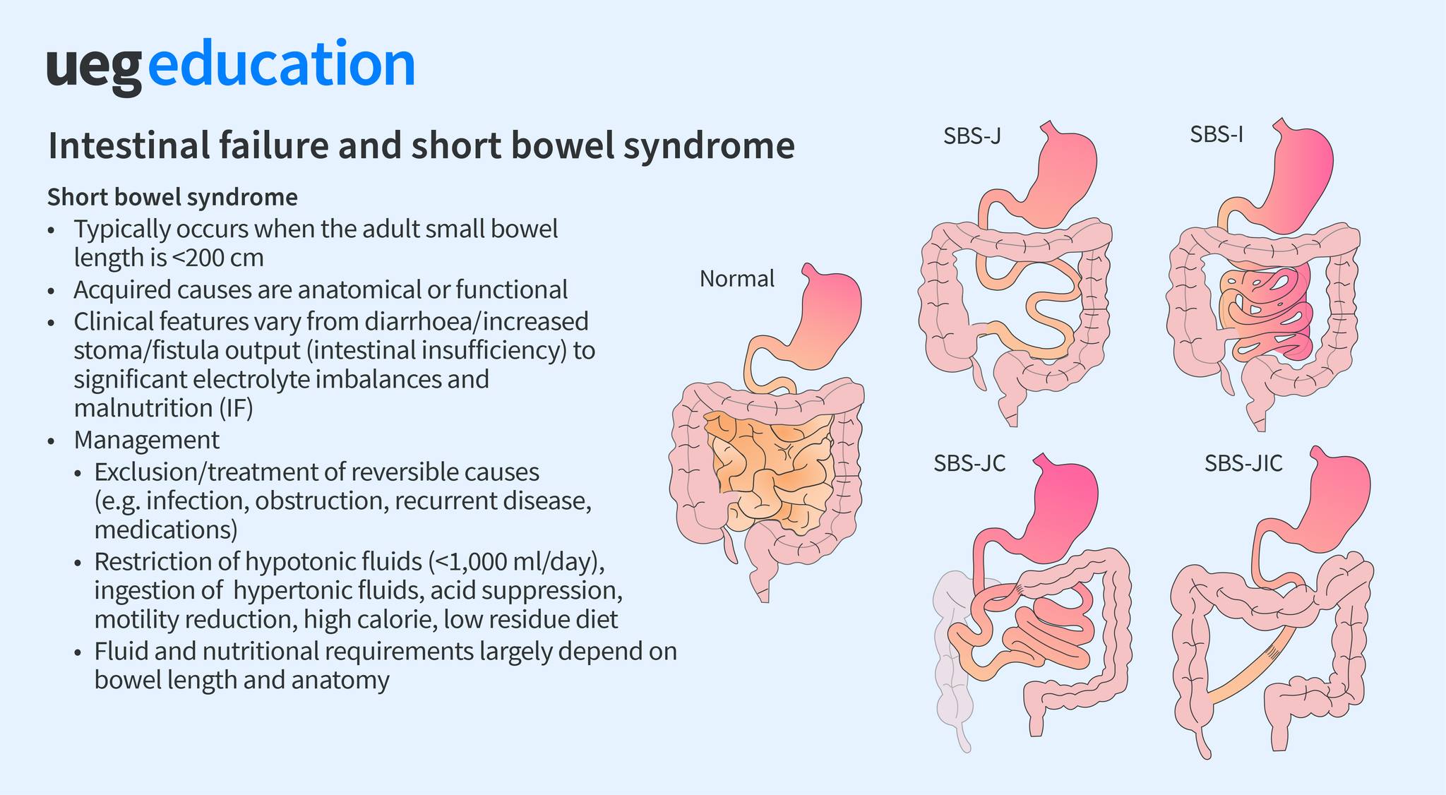 UEG - 🔵 Intestinal failure is the rarest organ failure, but its ...