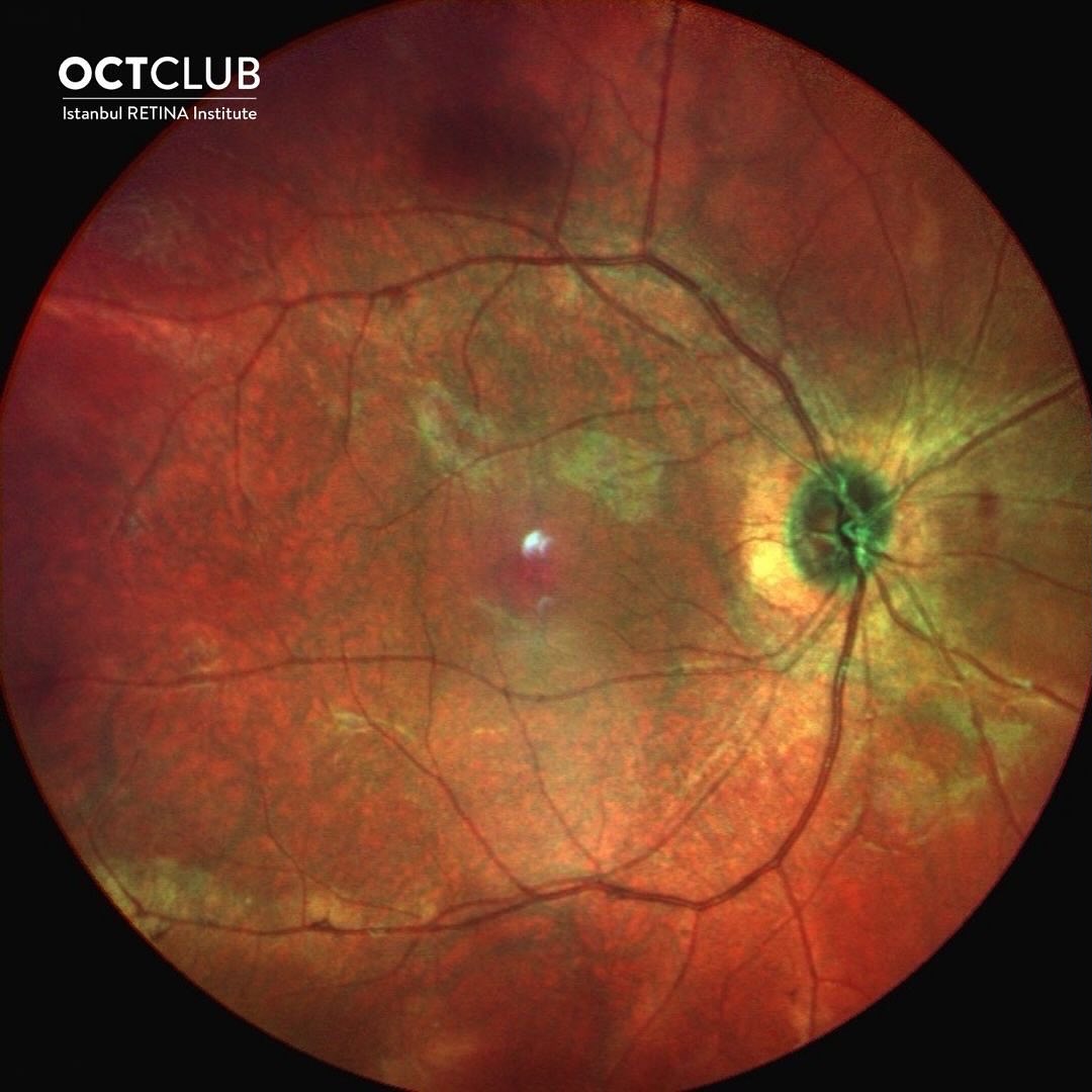 OCT Club