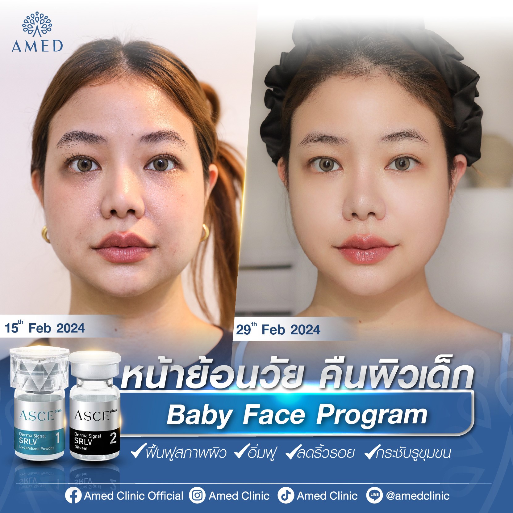 โกงอายุผิวด้วย Baby Face Program... - Amed Clinic Official | Facebook
