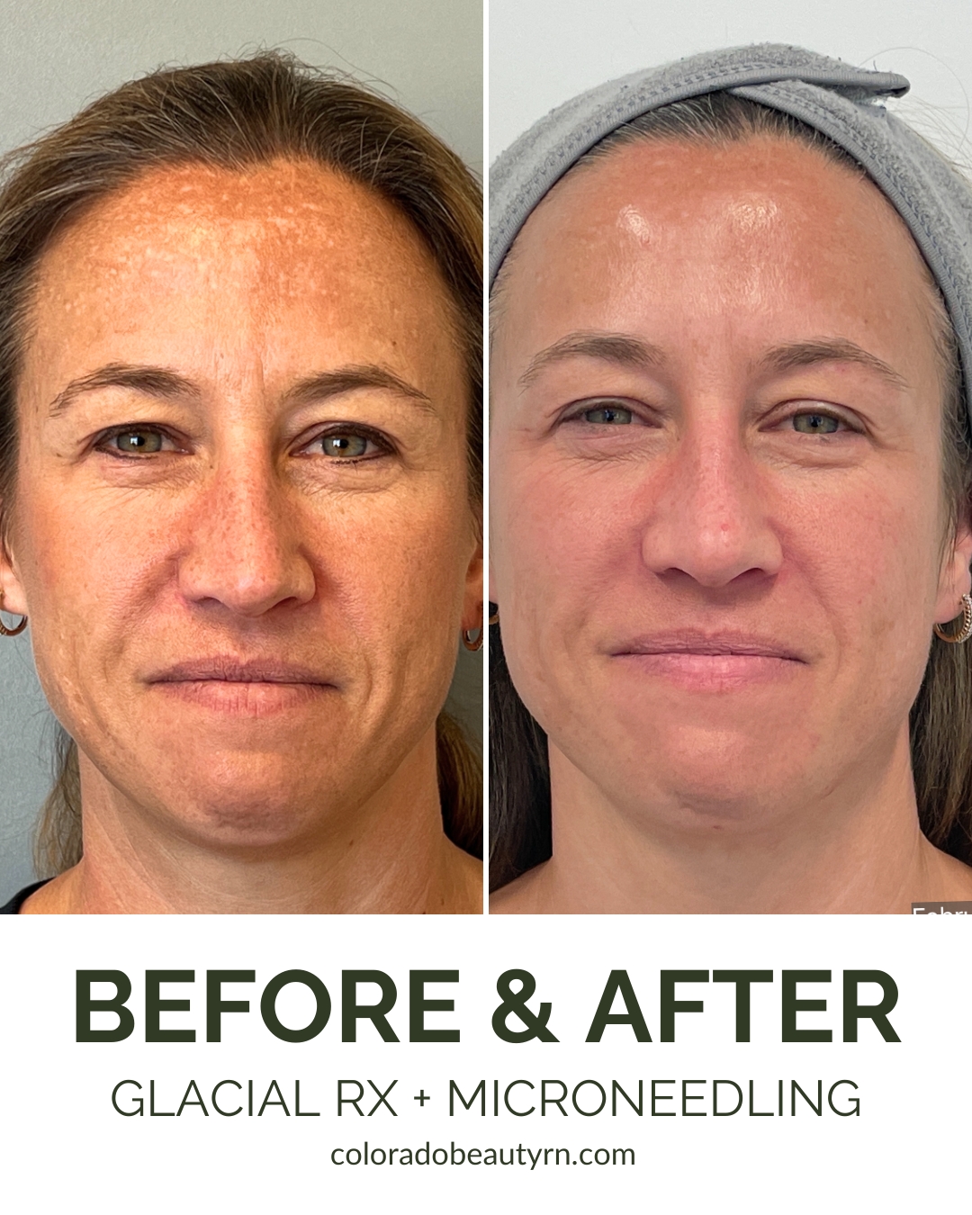 Colorado - Say goodbye to hyperpigmentation with the golden combo ...