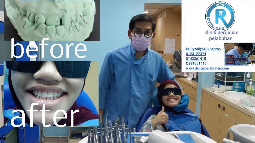 Klinik Pergigian Pelabuhan Port Klang Klinik Kami Membuat Braces Pendakap Gigi Conventional Self Ligation Dan Clear Aligner Facebook