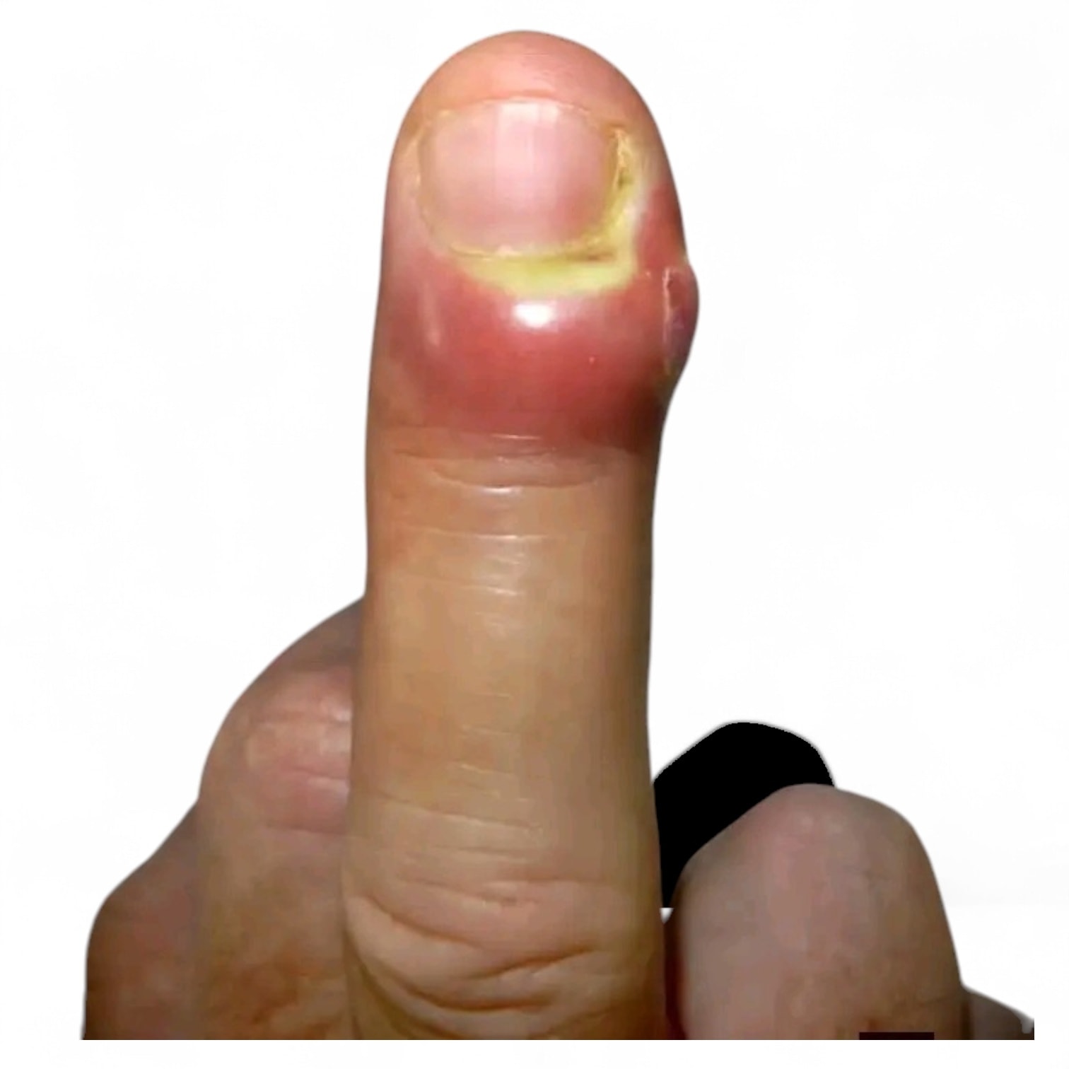 melanotic whitlow hutchinson Subungual melanoma: An important tip Jonathan Hutchinson  A multispecialist  Search Results: Thumb, Rash or