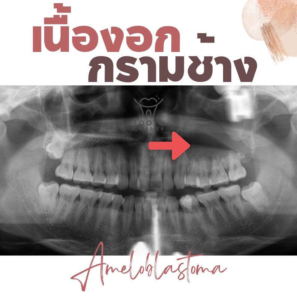 🐘🐘เนื้องอกกราม... - Tooth Corner Clinic - ทูธคอร์เนอะ สหคลินิก | Facebook