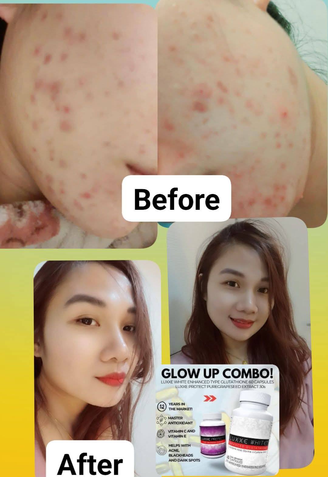 Users are living their best glow life with Lumi Glutathione Capsules! 😍 Super effective and backed by real feedback from our users who love their healthy glow. Kaya ikaw, mag-LUMI ka na!