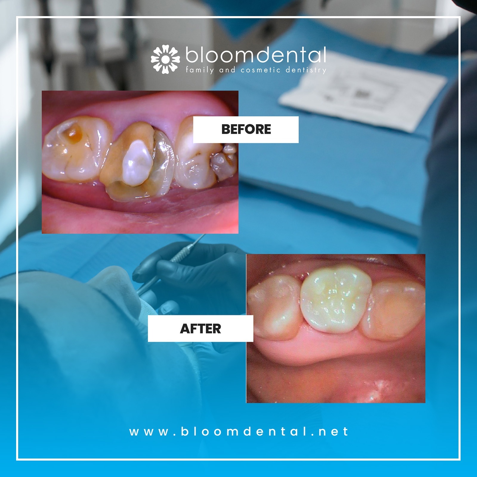 Bloom Dental - Bondings can help restore chipped or cracked teeth very ...