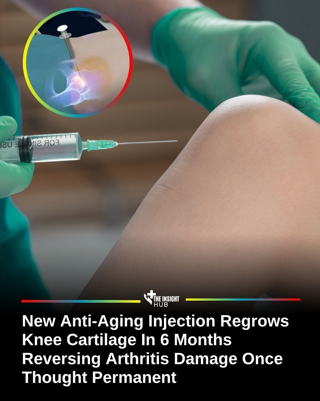 can bpc 157 regrow cartilage New anti-aging injection regrows knee in six months TB-500 5mg (Thymosin Beta-4) Symptoms of vitamin B12 deficiency Color:Orange