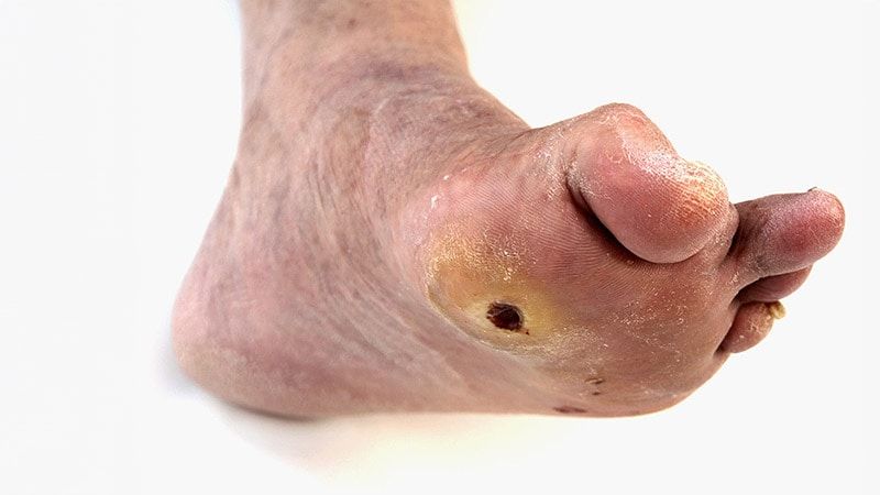 Diabetic Foot Ulcers: Life-Threatening Issue in Need of Help