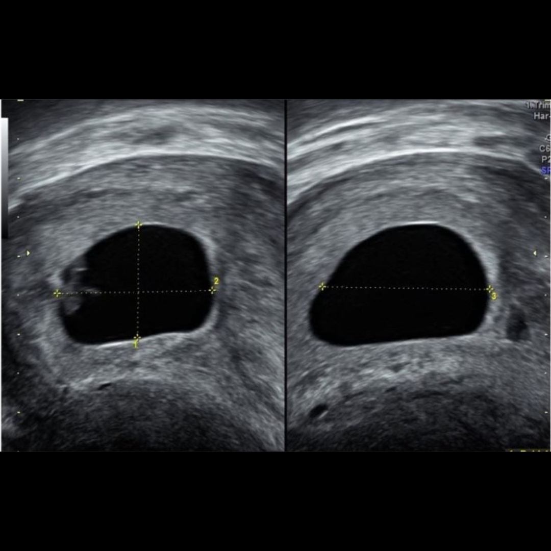 Today's Friday #ISUOGEducation quiz looks at first-trimester pregnancy ...