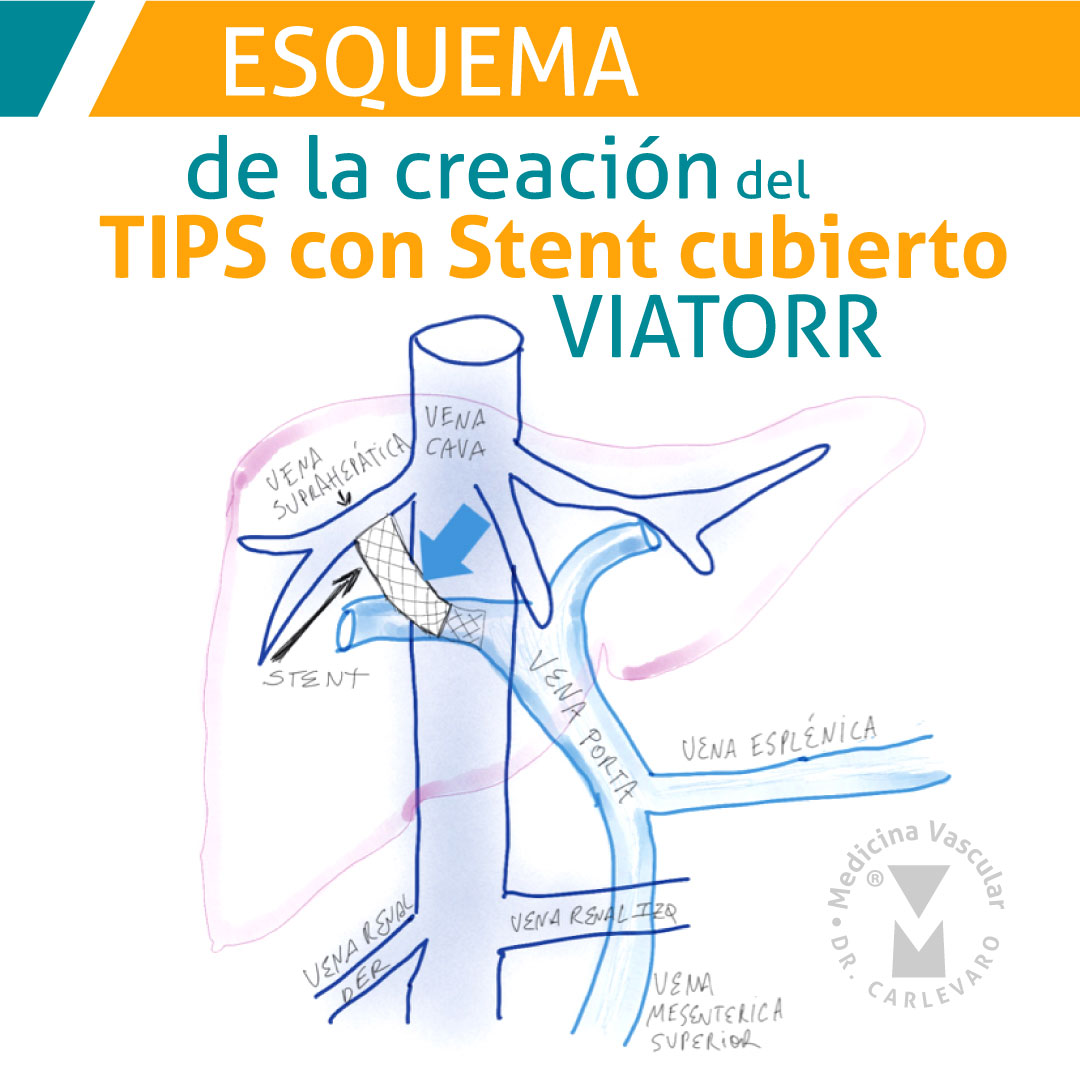 Medicina - El TIPS es un procedimiento que se realiza en la práctica ...