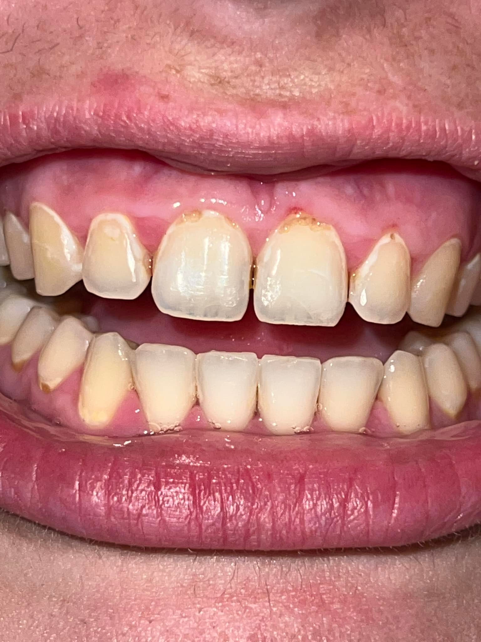 glutathione side effects teeth decalcification What could be causing and gum recession? CDC Vaccine Recommendation Changes skinbrightning Select Pack::180 Sachets