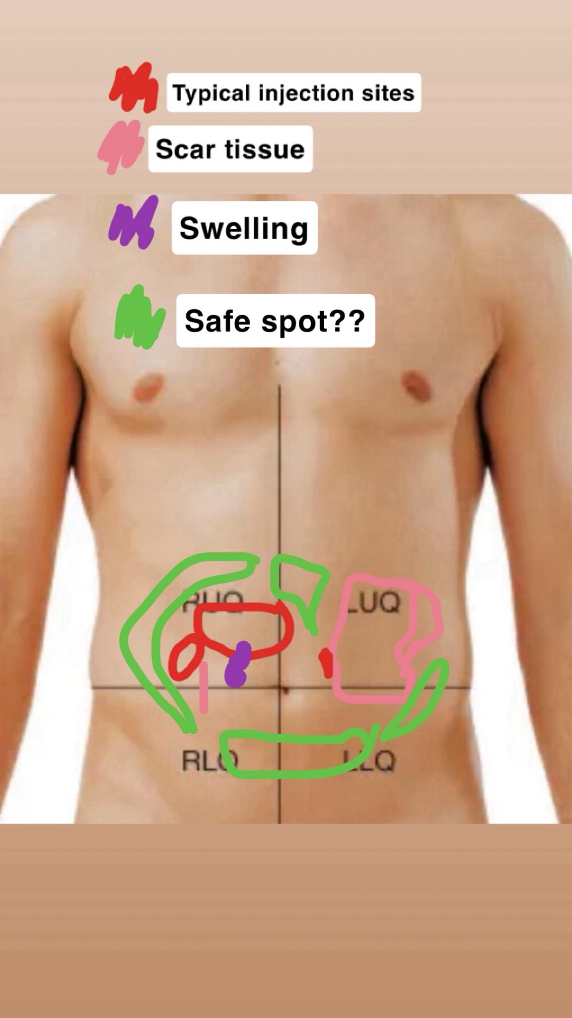 What happens when injecting near the belly button?