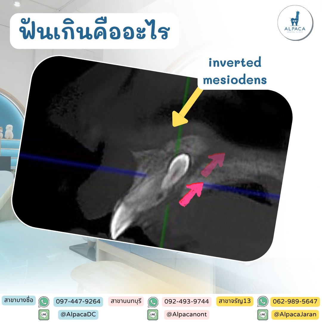 🦷 Mesiodens คืออะไร? ฟันเกินบริเวณหน้ากลางที่พบบ่อยที่สุด ฟันเกิน ...