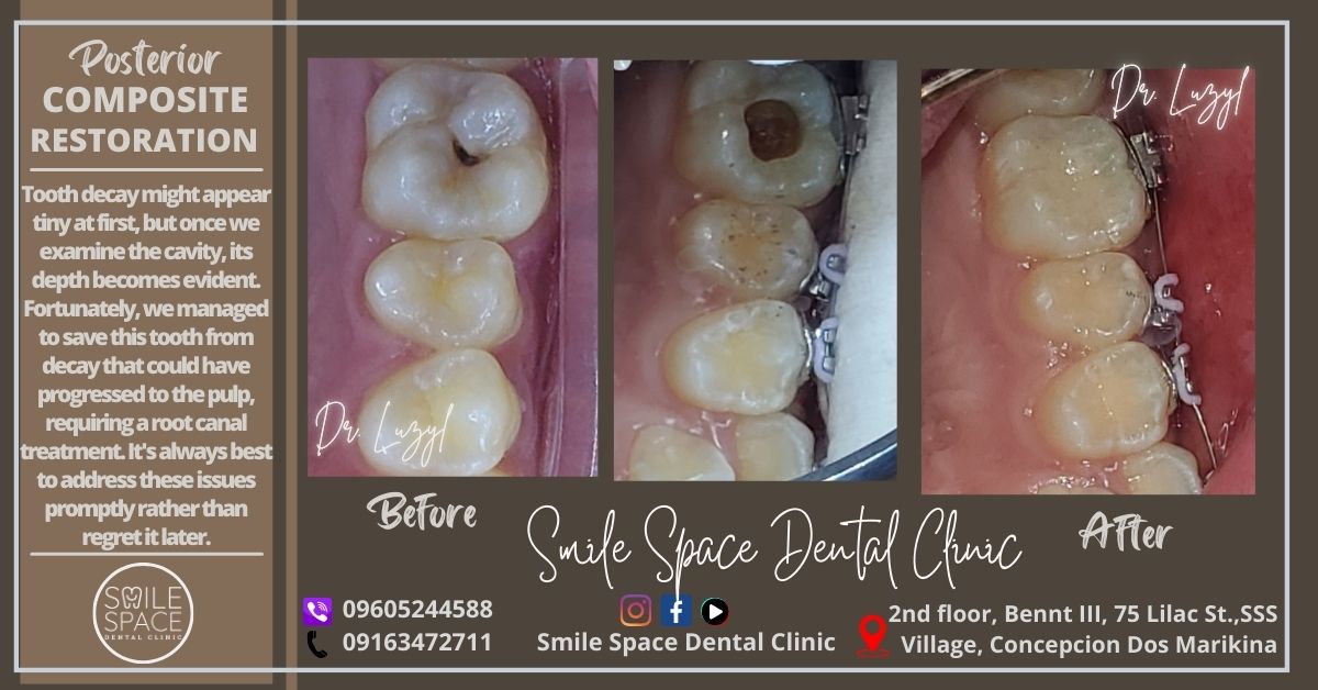 Smile - Tooth decay might appear tiny at first, but once we examine the ...