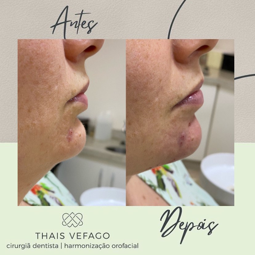 💎 TRATAMENTO: Preenchimento na... - Dentista Thais Vefago