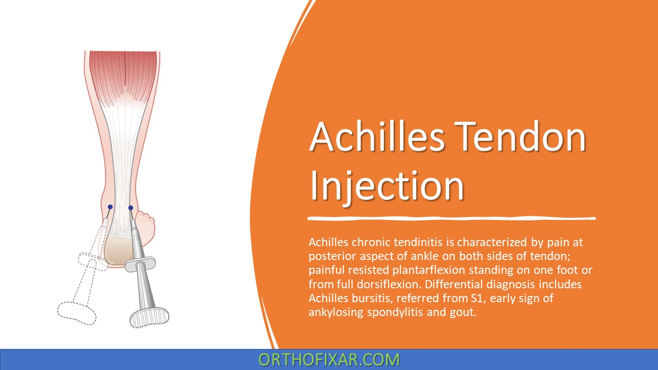 Botox injection for achilles tendon surgery preparation