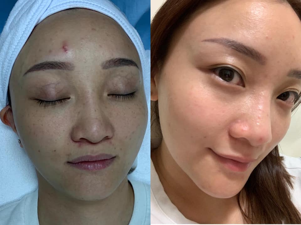經過... - I-Laser Beauty/皮秒/激光/淡斑/嫩膚/Pico/Laser/單次收費/美容/觀塘店/近地鐵站 | Facebook