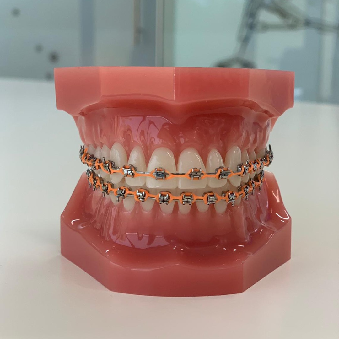 Ortholuna orthodontie - Waarvoor is het draadje achter je tanden aan ...