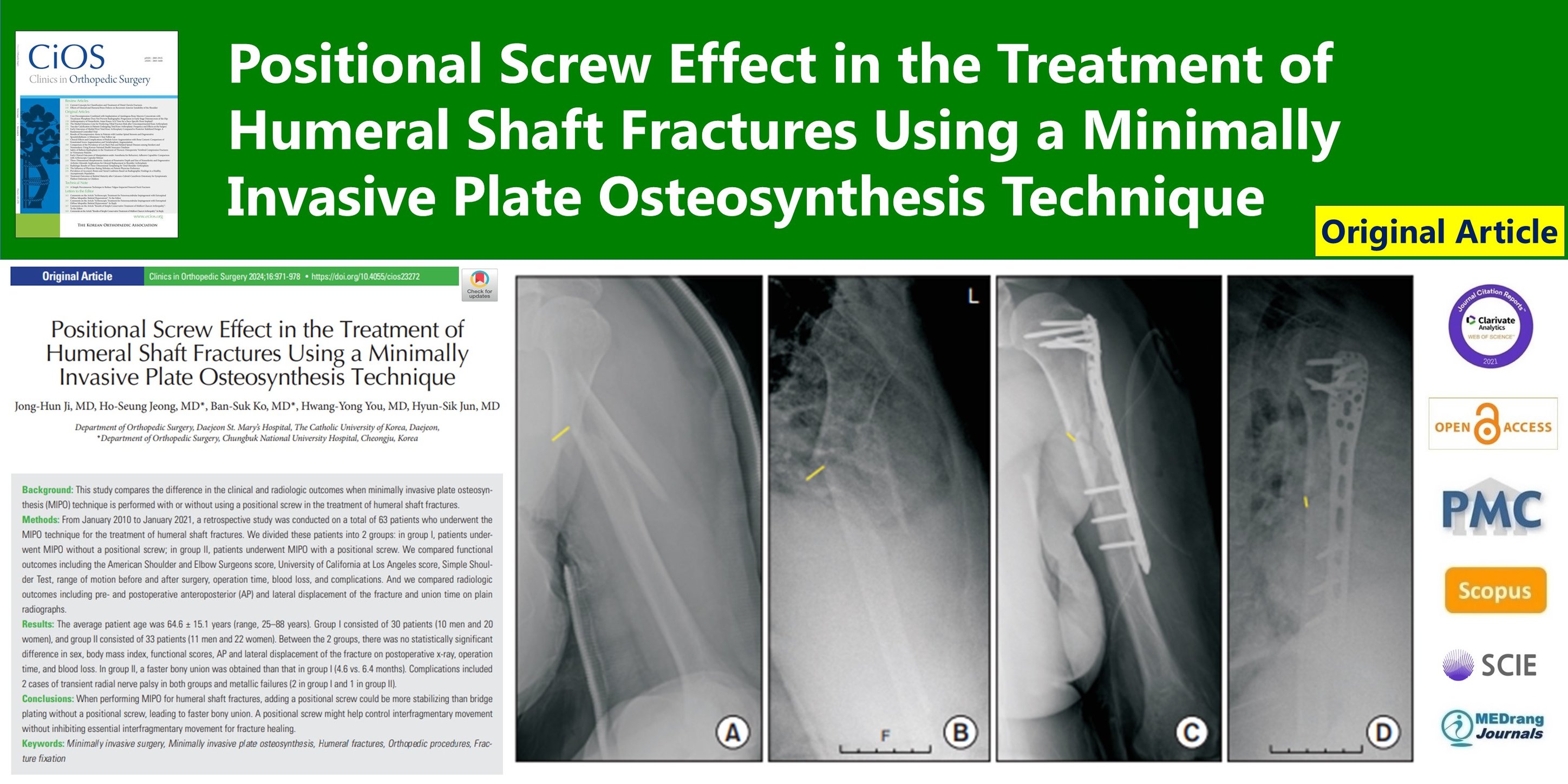 Clinics - Positional Screw Effect in the Treatment of Humeral Shaft ...