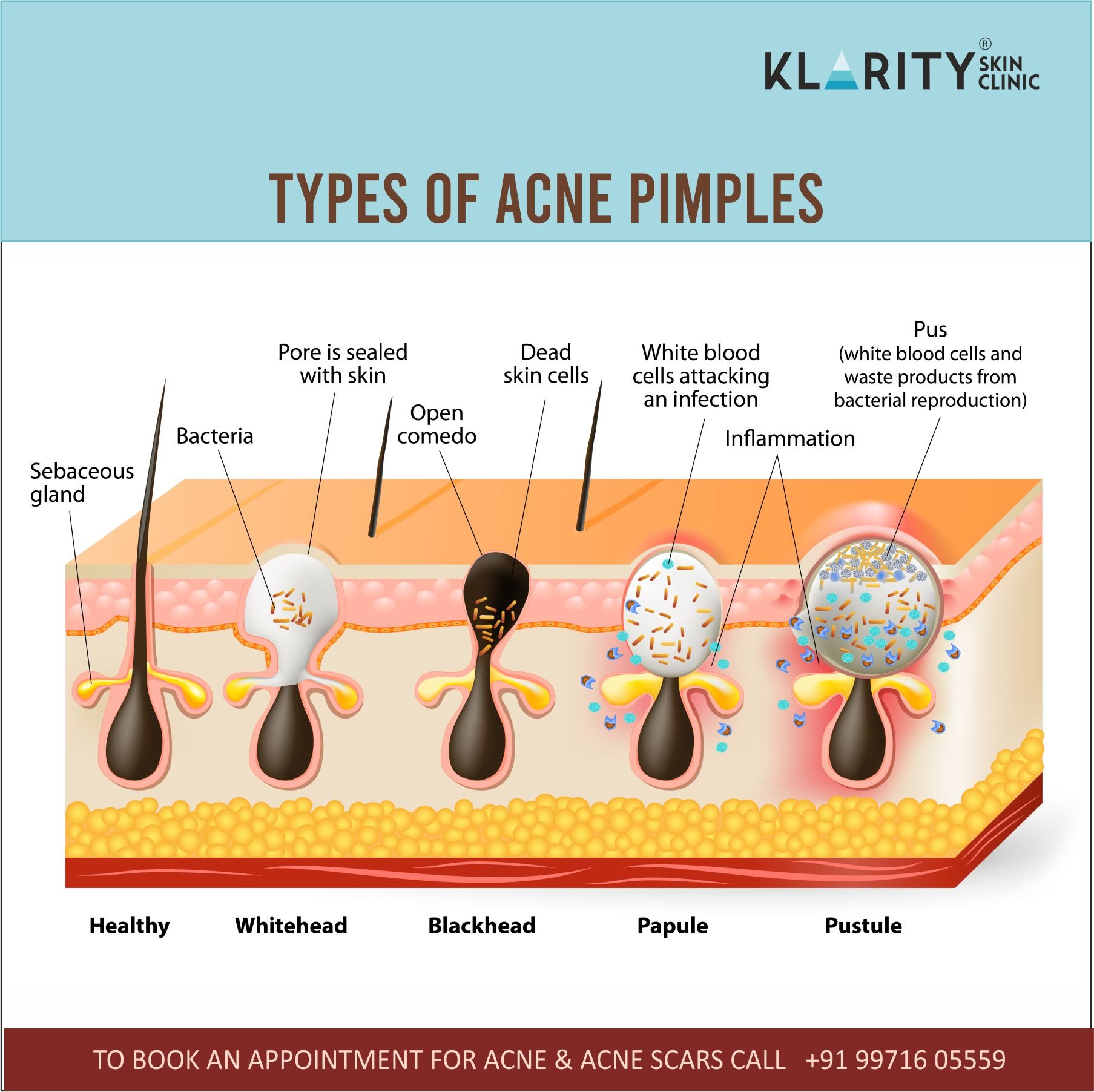 Did you know how acne pimples are... - Klarity Skin Clinic | Facebook