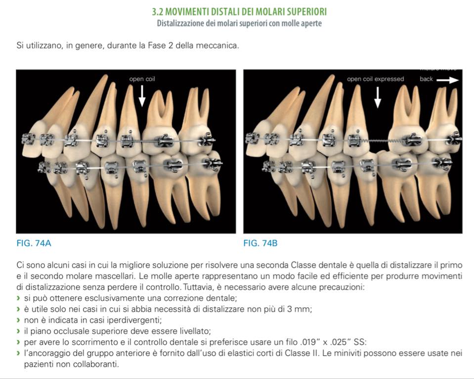 OrthoTeam - La distalizzazione dei molari superiori con le...