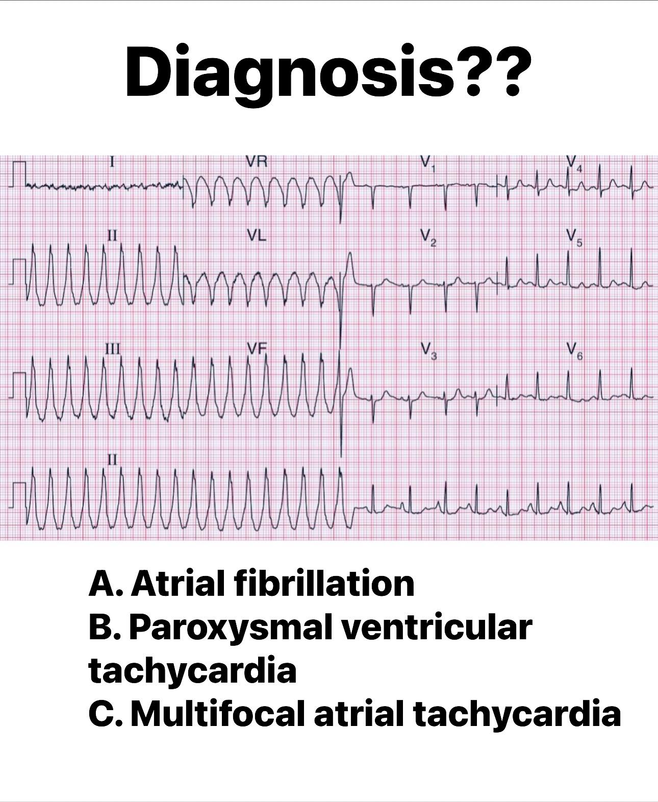 What is the diagnosis for a 62-year-old man with palpitations and