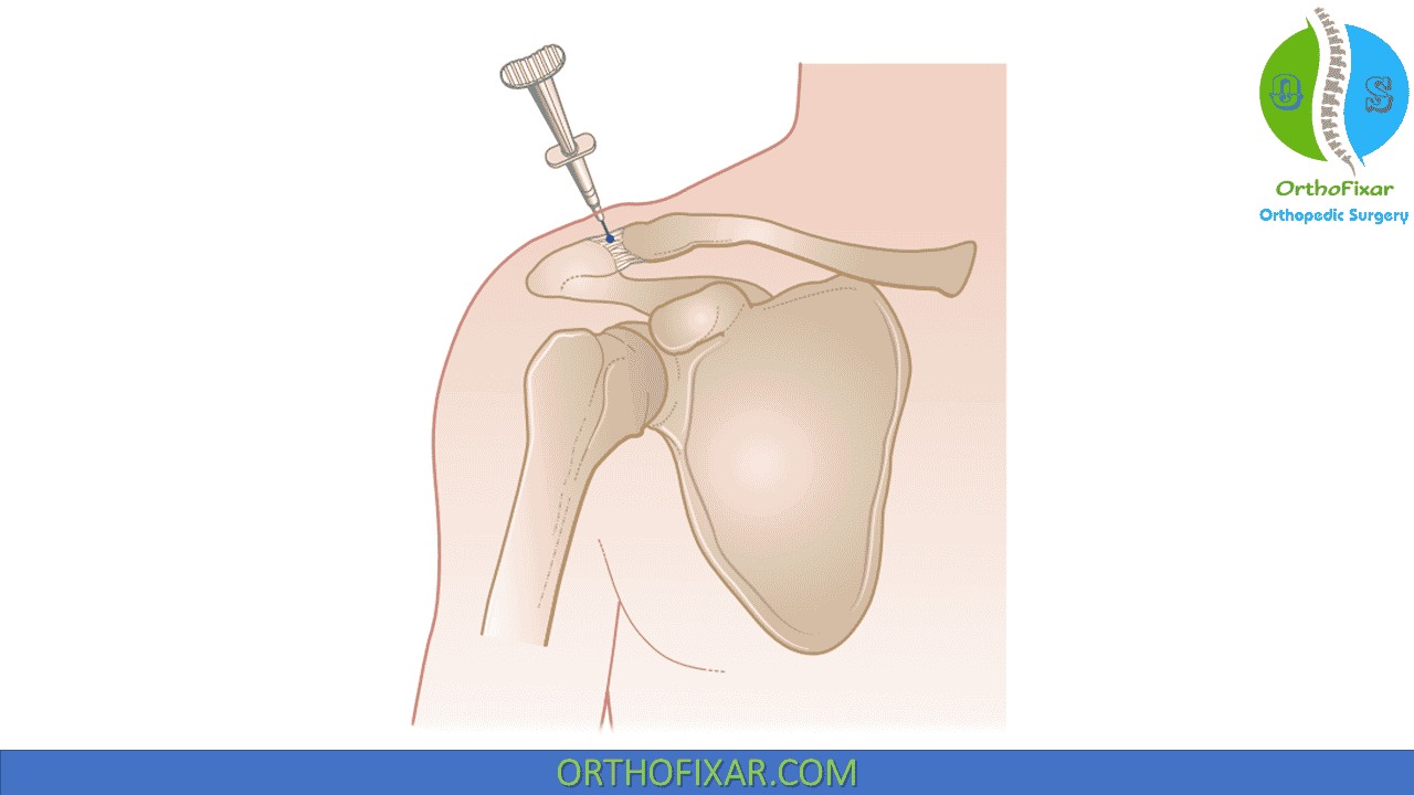 where to inject klow for shoulder pain? Glutathione Coated Plates for Gluta melony Option:2 bottles