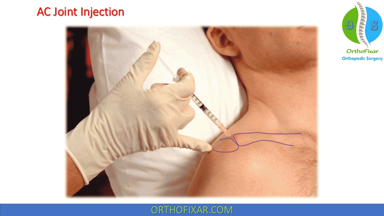 klow injection site Where to inject for shoulder pain? Tier 1 - Retail Packs:Pack of 10 Buy The Complete BPC-157