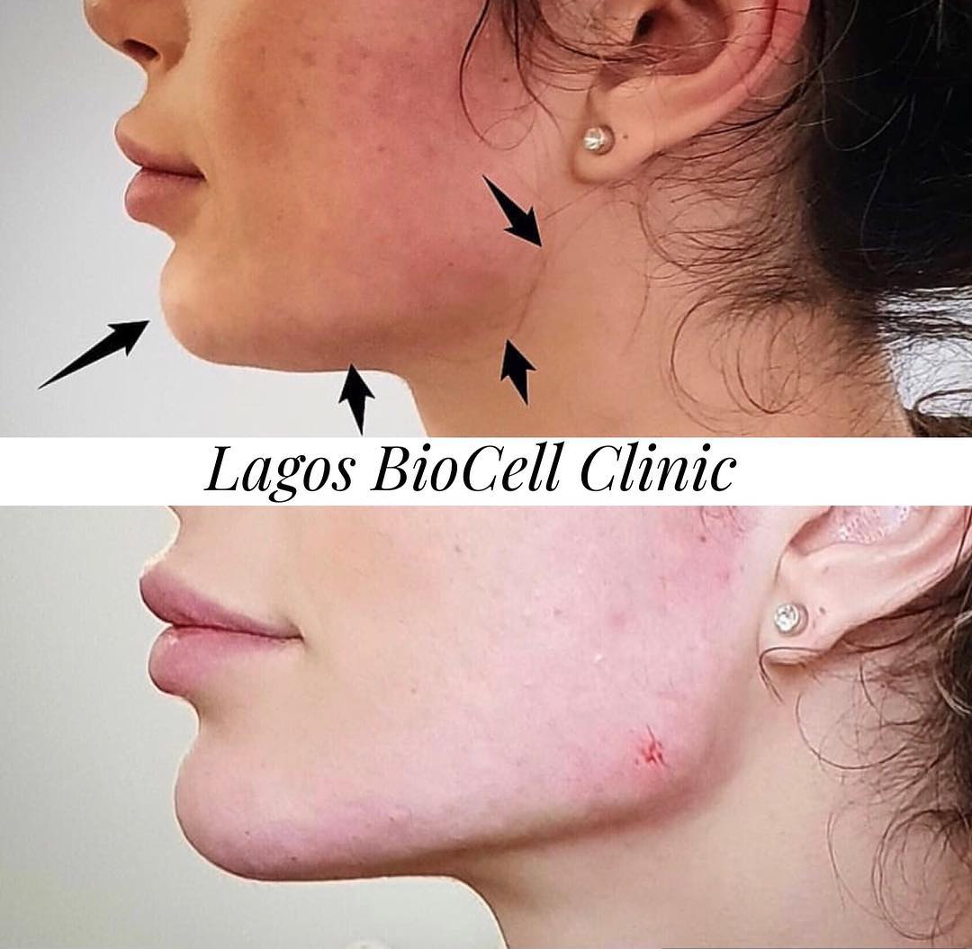 BioCell Clinic - Before and immediately after chin,...