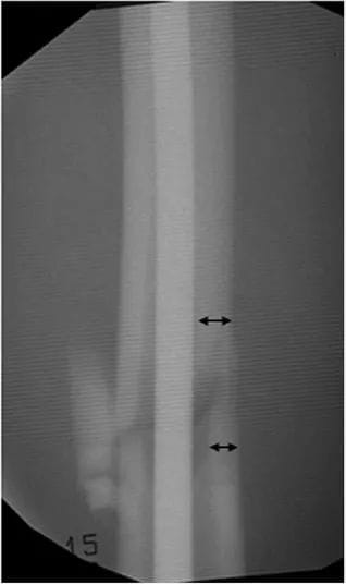 The cortical step sign : - Orthopaedic Cases Discussion | Facebook