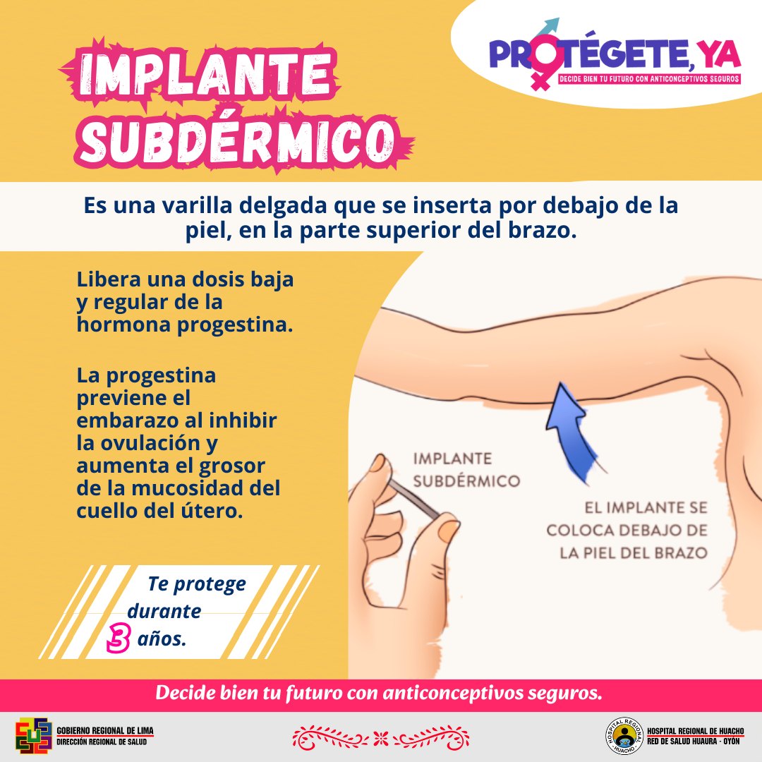 Hospital - El implante anticonceptivo femenino es un método altamente ...