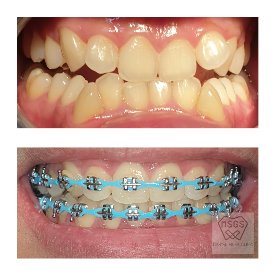 Midline Alignment Bite... - MSGS Dental Prime Clinic