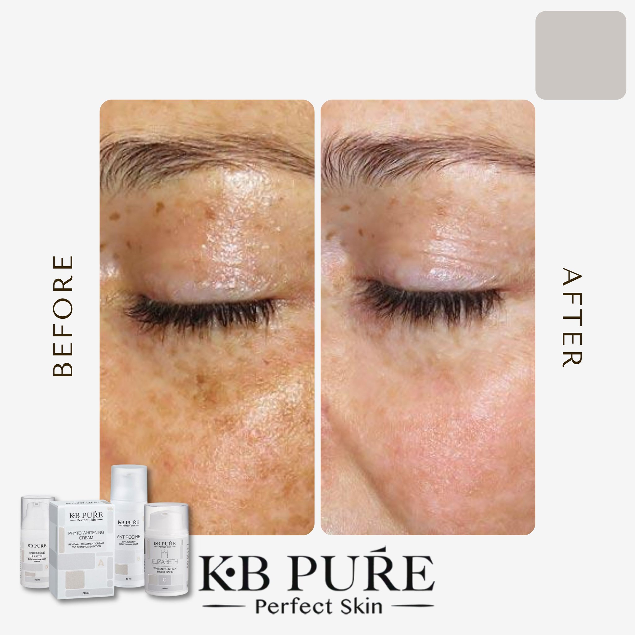kb glutathione before and after ✨ Real skin. Real results. ✨ & results using PURE active skincare Targeted formulas designed to help reduce the appearance of dark spots, uneven skin tone, visible pigmentation — Cagrilintide (Amylin Receptor Agonist)