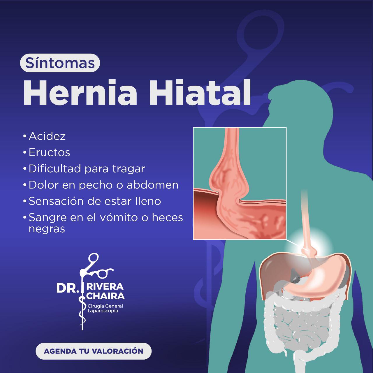 Dr. - 🔷La hernia de hiato es una afección en la cual la parte superior ...