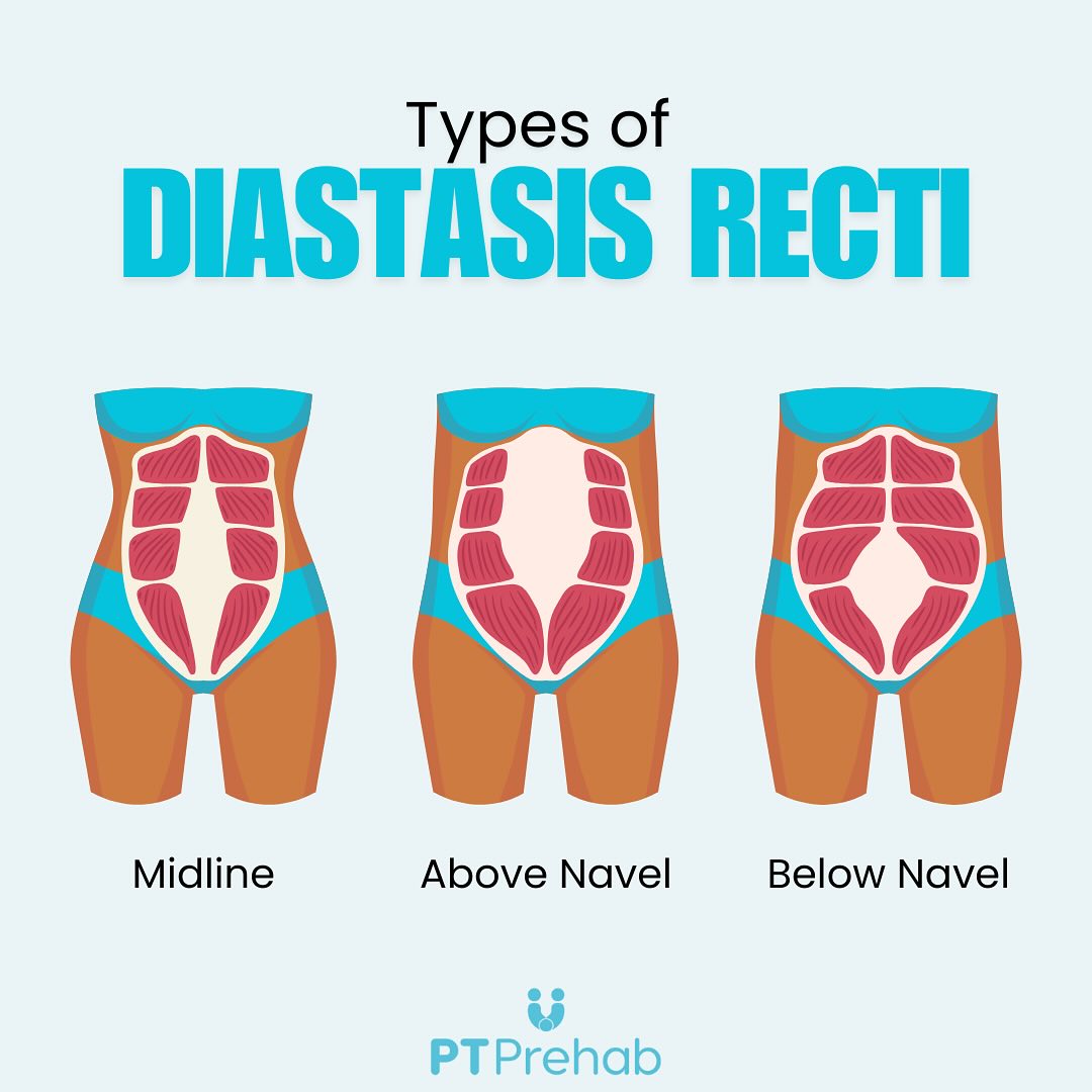 PT - 💡 Diastasis Recti 💡 Did you know that not all diastasis recti (DR ...