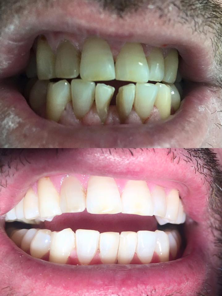 Briliant Dent - Pacienti në foto. - Incizivat Qendror (dhëmbët e par ...