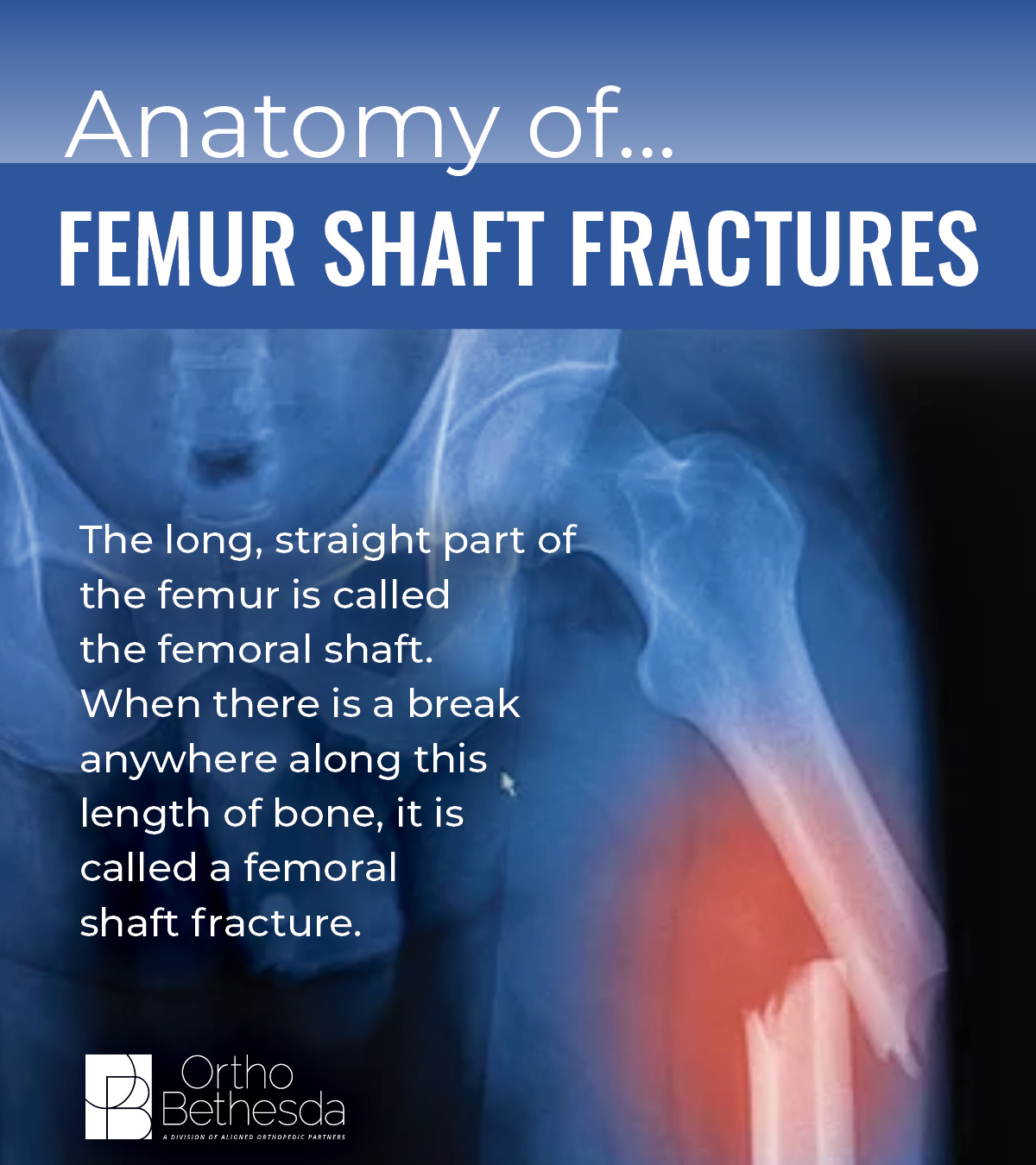OrthoBethesda - The severity of femur fractures can differ ...