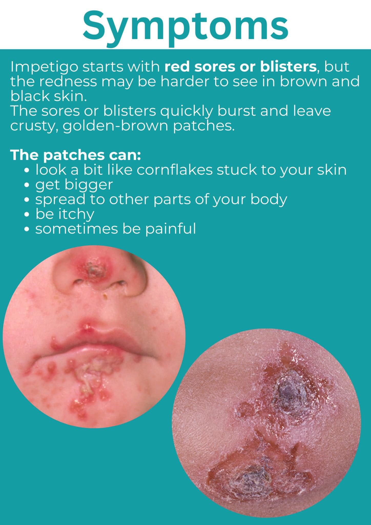 Impetigo In Nose What Is Impetigo And Should I Be Worried?