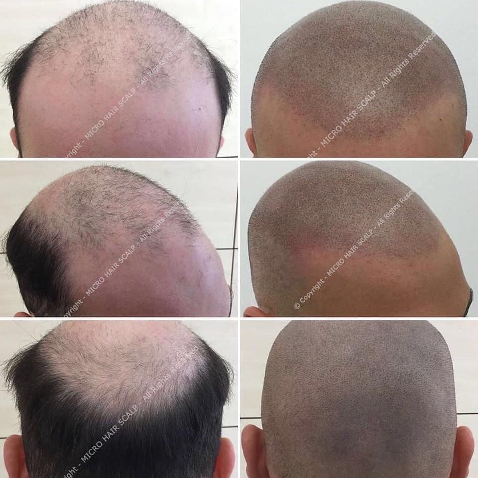 Micro Hair Scalp - passa al look rasato sempre alla moda continua la ...