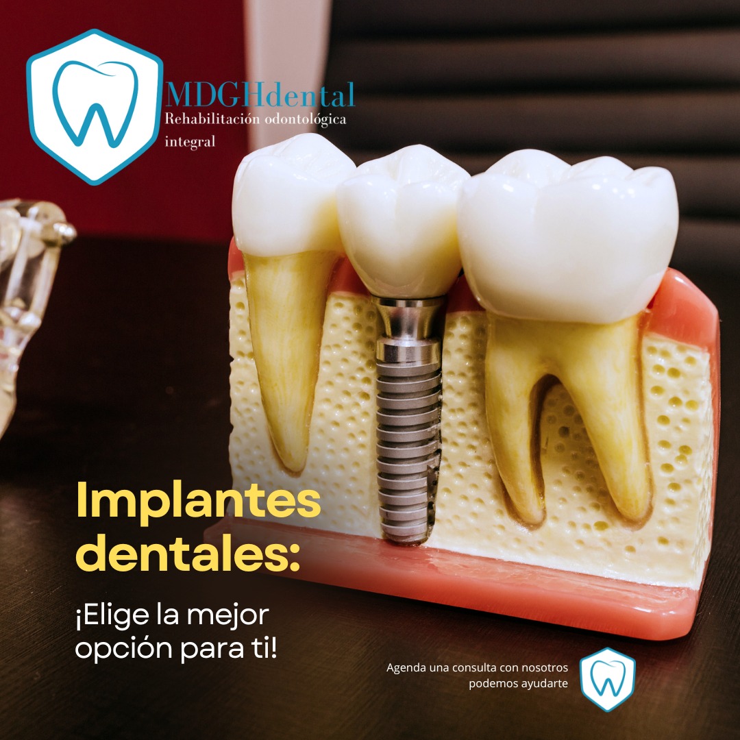 MDGH dental - 🦷 Implantes Dentales: ¡Elige la mejor opción... | Facebook