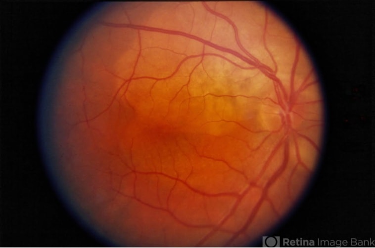 Ophthalmology-Notes And Synopses - Choroidal Osteoma: ️Choroidal ...