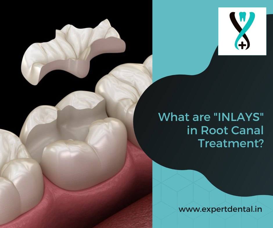 🦷 Definition: Inlays are dental... - Expert Dental Care