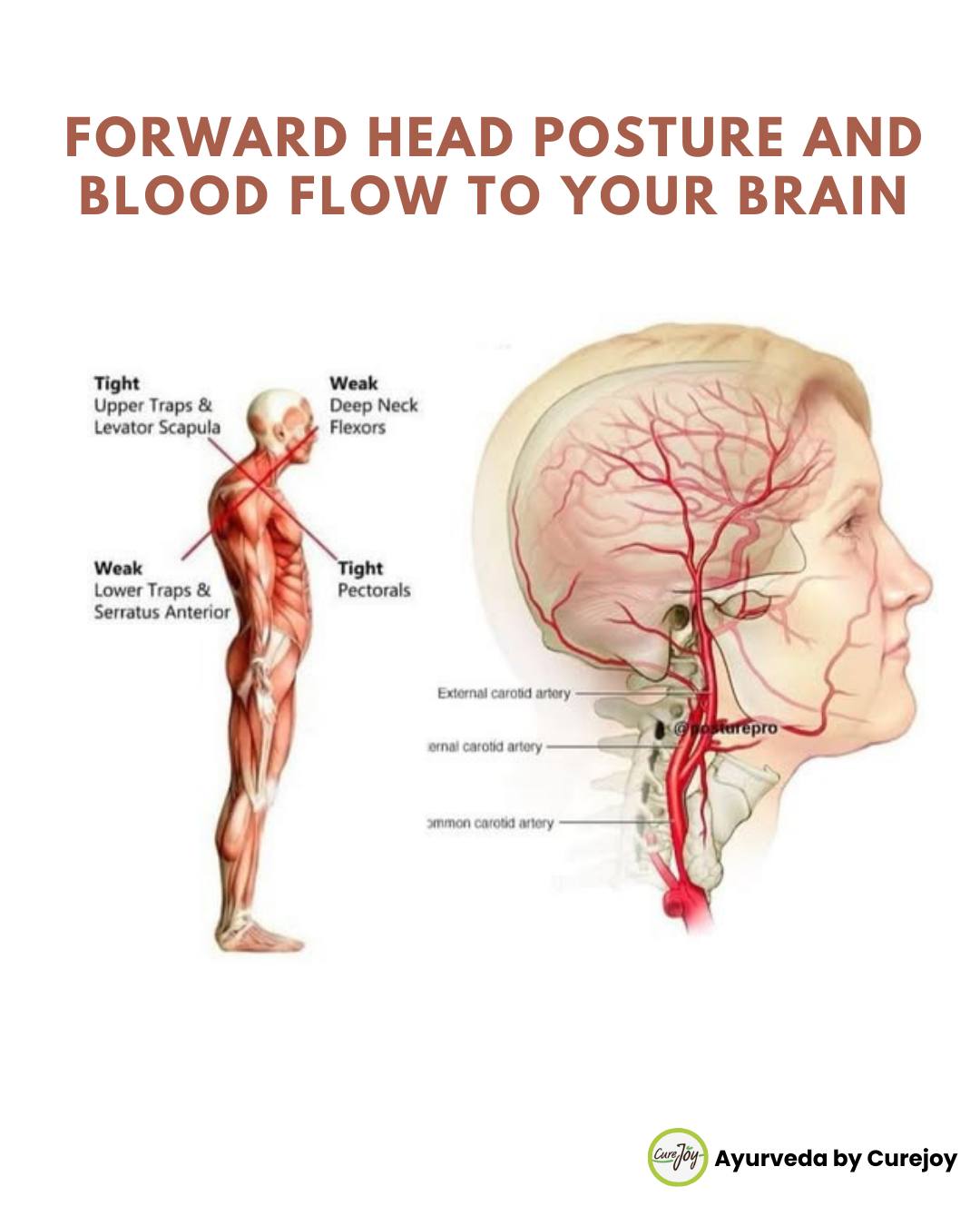 Ayurveda by Curejoy - Your posture matters more than you think! Forward ...