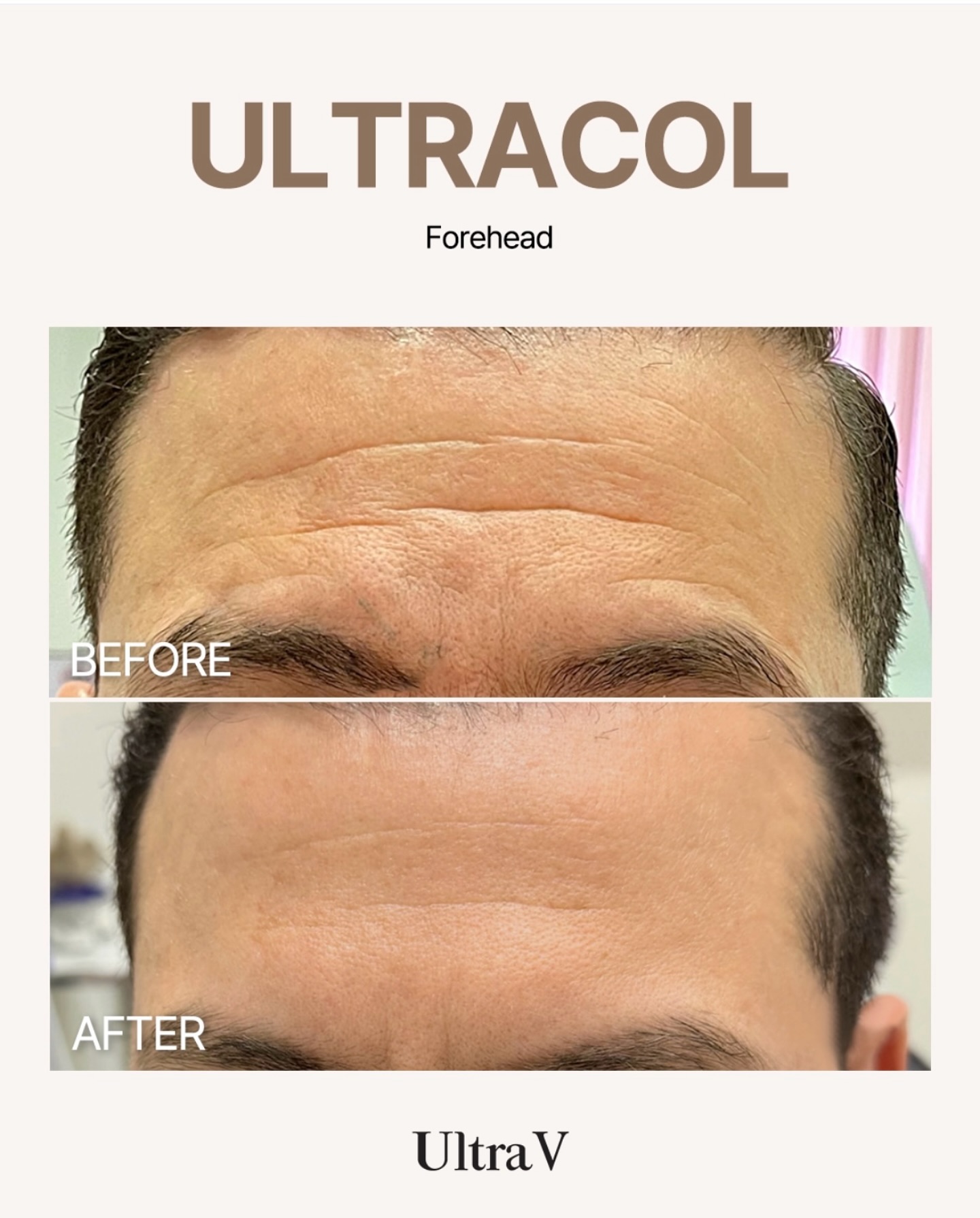 Ultra-V Medical