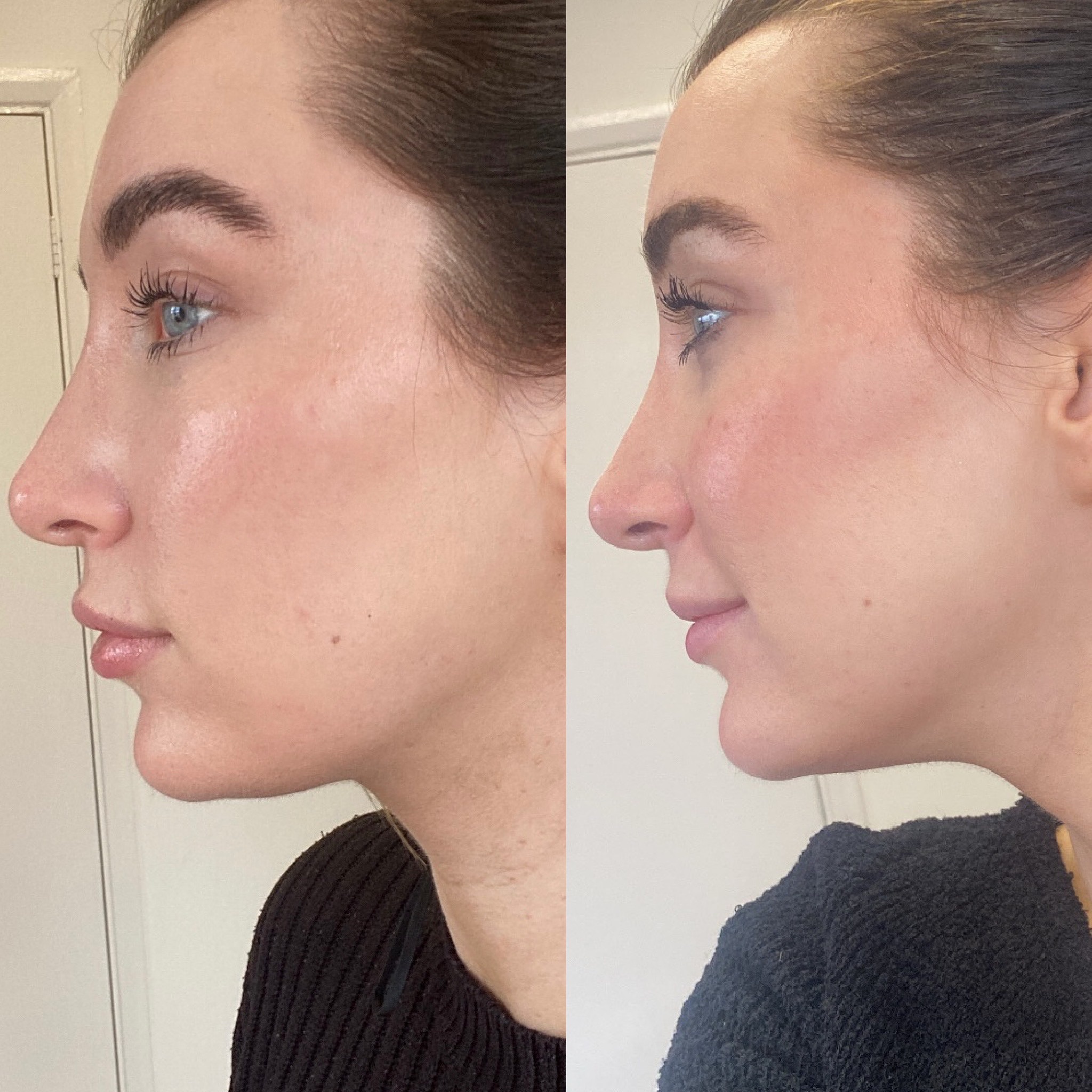 Lemon bottle results @gracefulbeauty_salon after just one session😍 This is great for those stubborn fat pockets like under the chin. @gracefulbeauty_salon offers lemon bottle fat dissolving at our studio twice a week😍💖