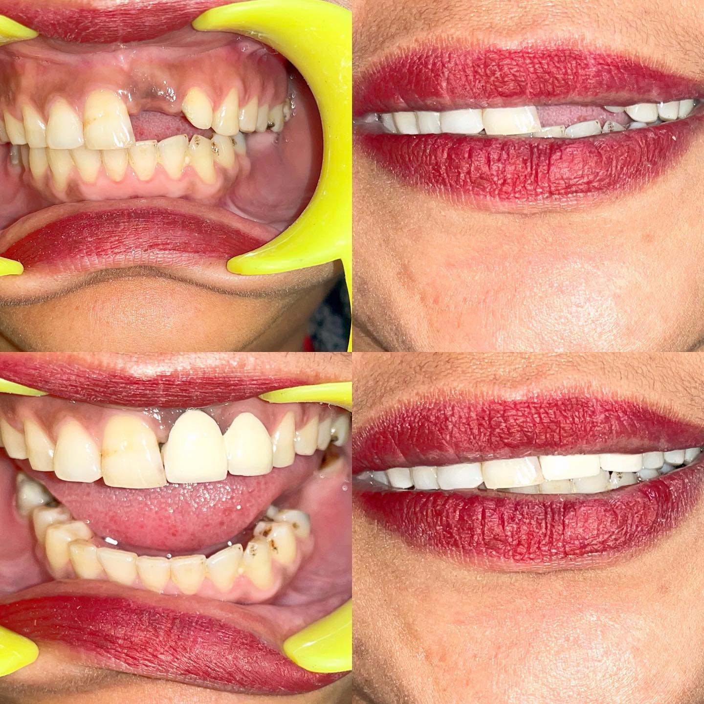 Fixed Partial Denture.! Camouflaging the lost anterior teeth with crown ...