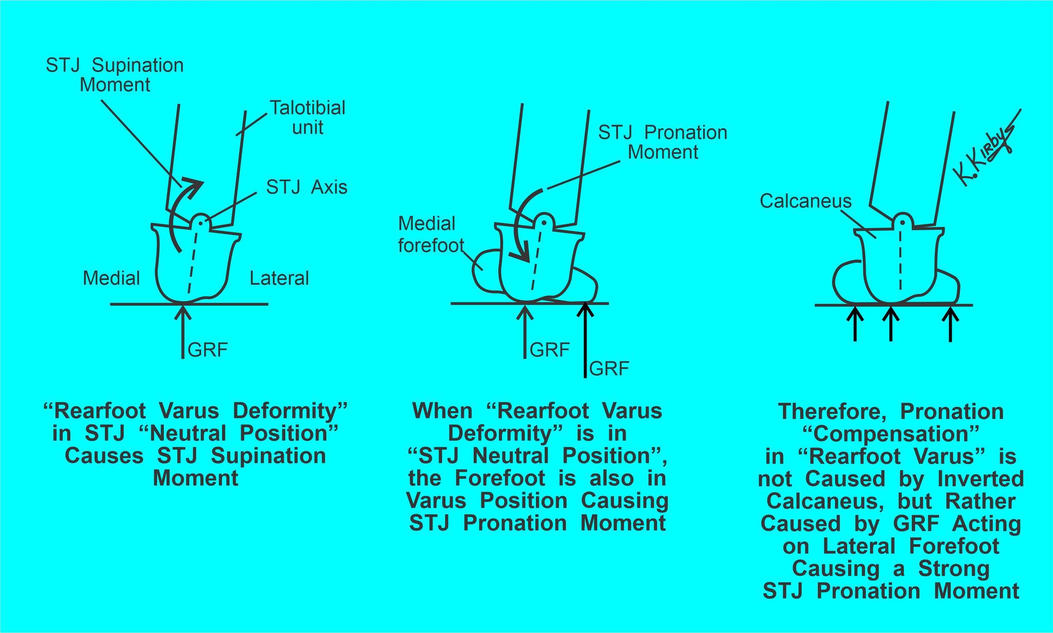 Rearfoot Varus 