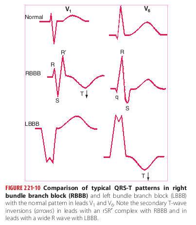 Doctordconline - LBBB vs RBBB (ECG) Left Bundle Branch Block A complete ...