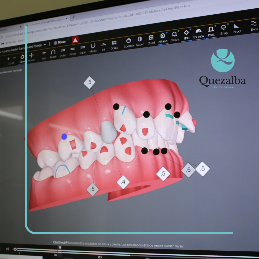 Dental Quezalba - Te presentamos ClinCheck: el software...