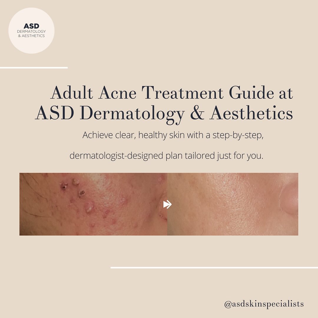 Struggling with adult acne?... - ASD Dermatology & Aesthetics | Facebook