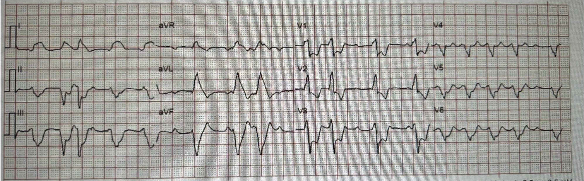 Sudden shock with a Nasty looking... - Dr. Smith's ECG Blog